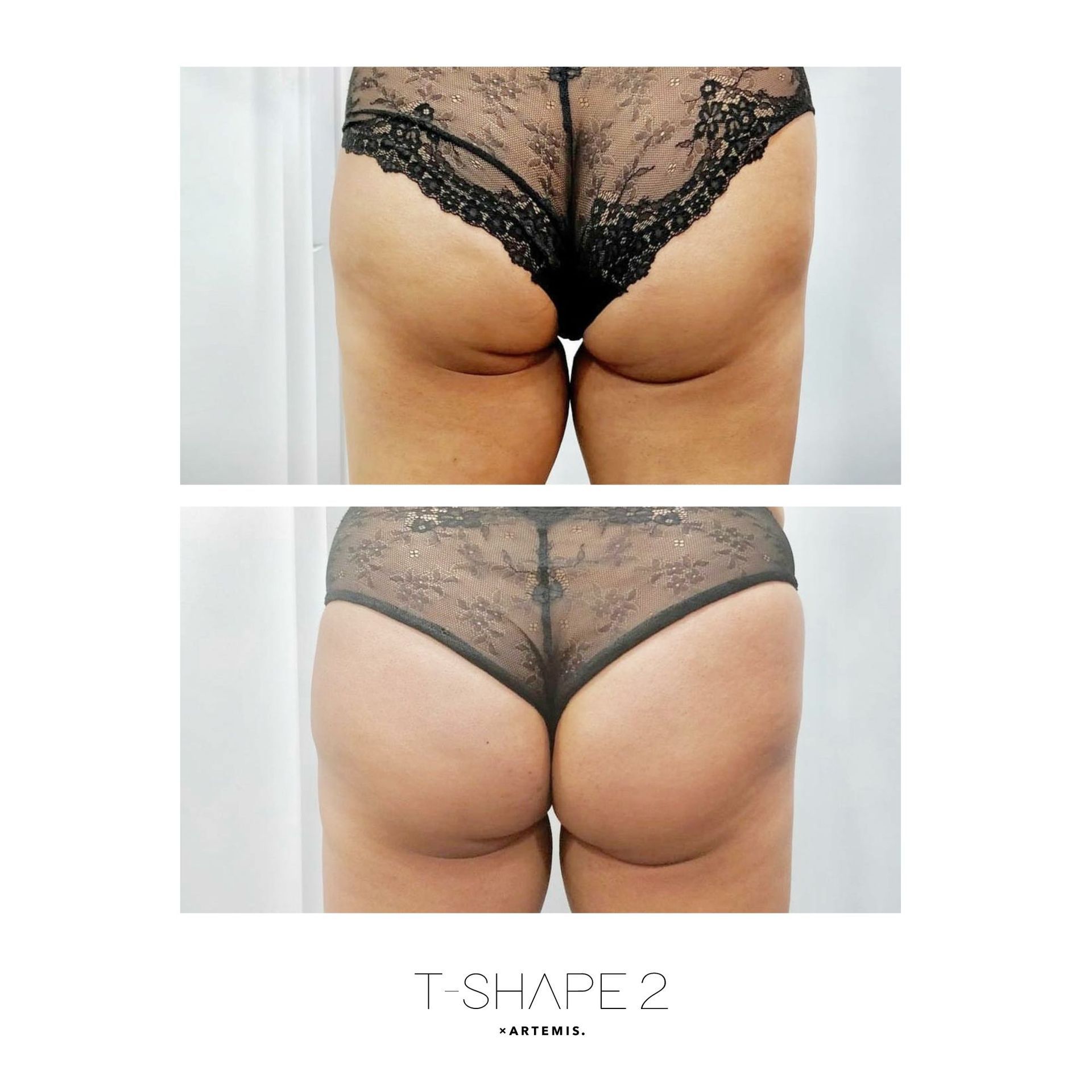 An Artemis T-Shape 2 before and after of a woman's buttocks.