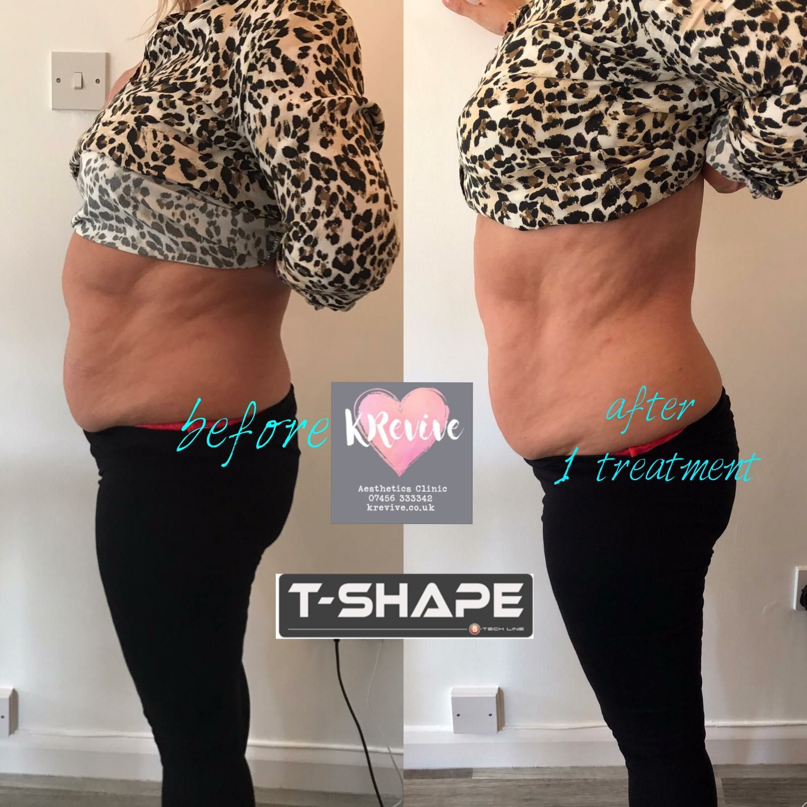 An Artemis T-Shape 2 before and after of a woman's belly.