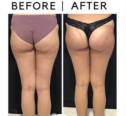 An Artemis T-Shape 2 before and after of a woman's glutes and legs.
