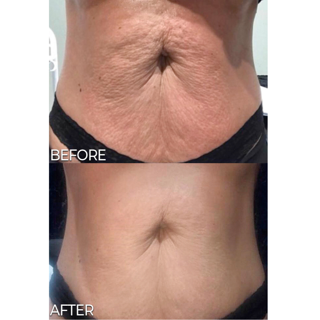 An Artemis T-Shape 2 before and after of a woman's belly.