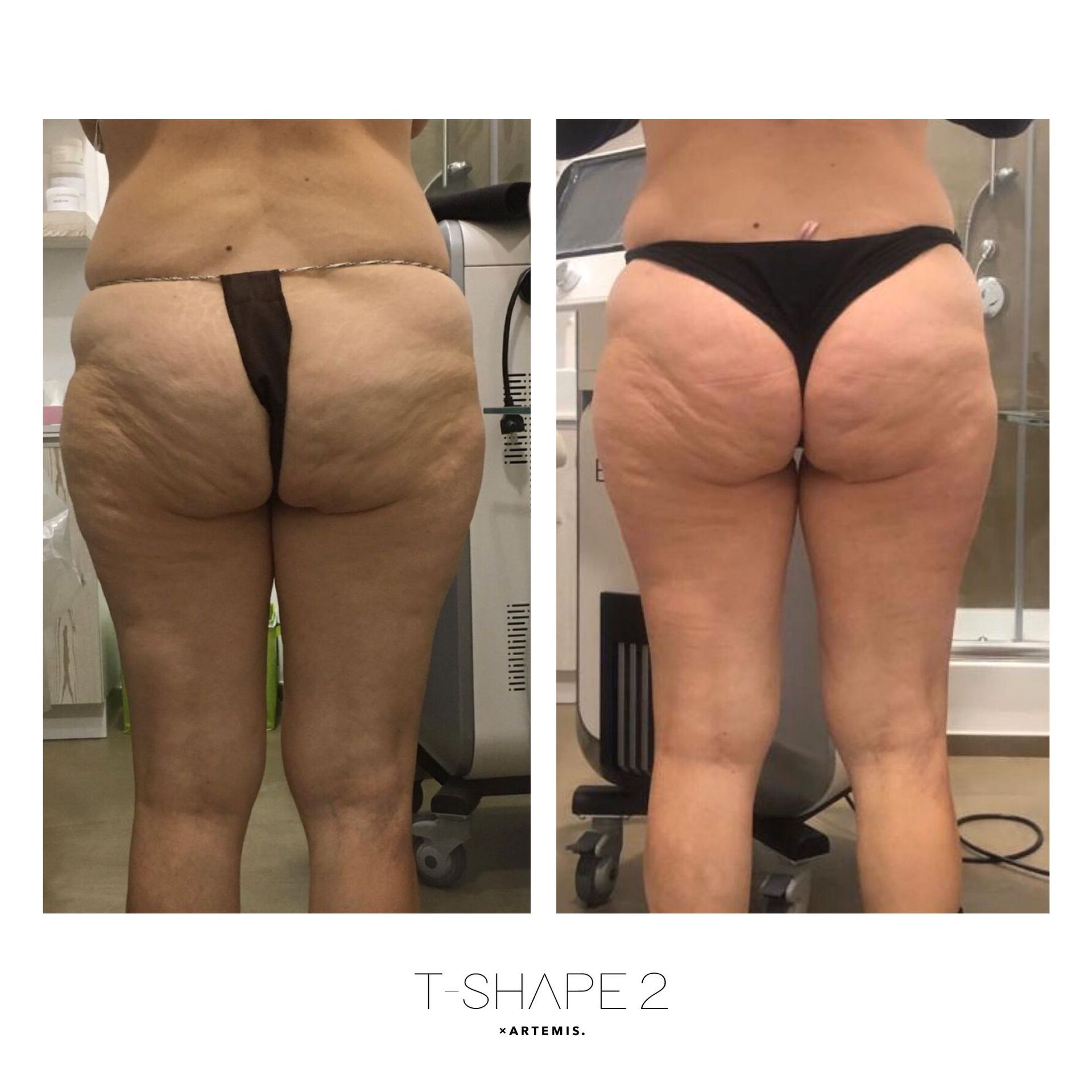 An Artemis T-Shape 2 before and after of a woman's glutes.