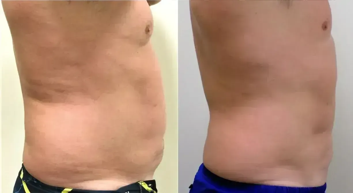 Side-by-side view of a torso showing a reduction in fat after treatment. The person is standing, in profile.