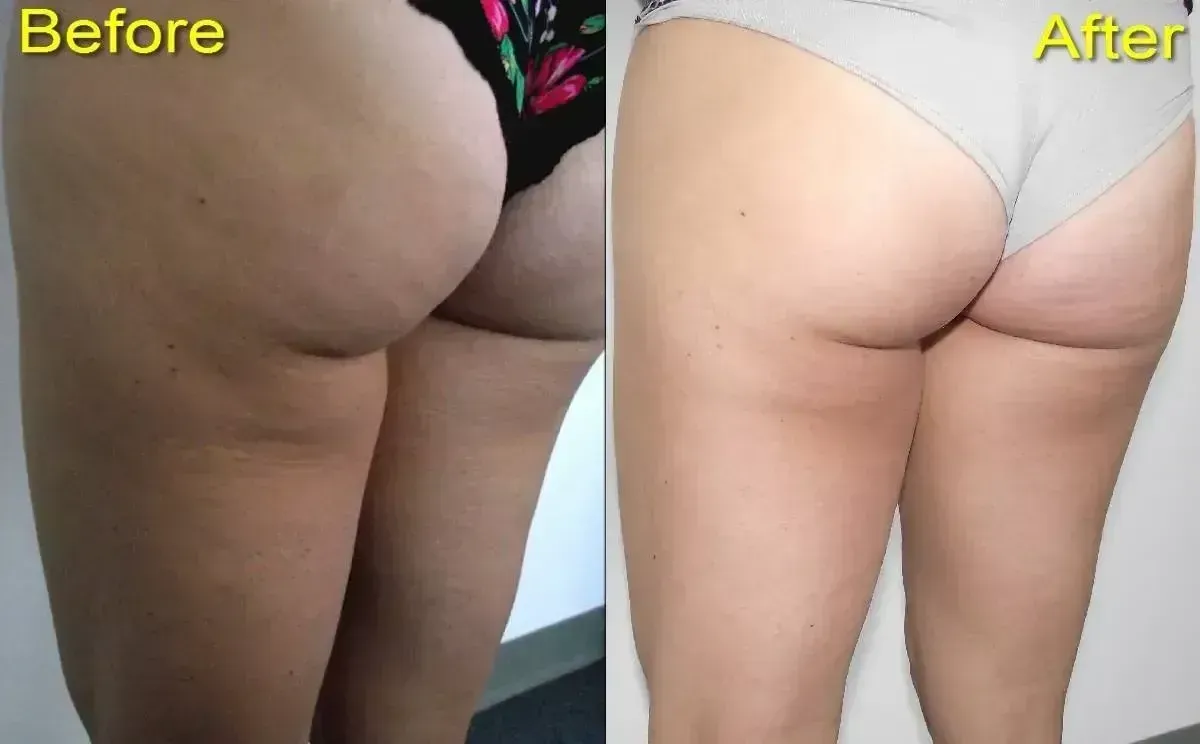 Comparison of a person's thigh and buttocks before and after a treatment, showing a reduction in cellulite.