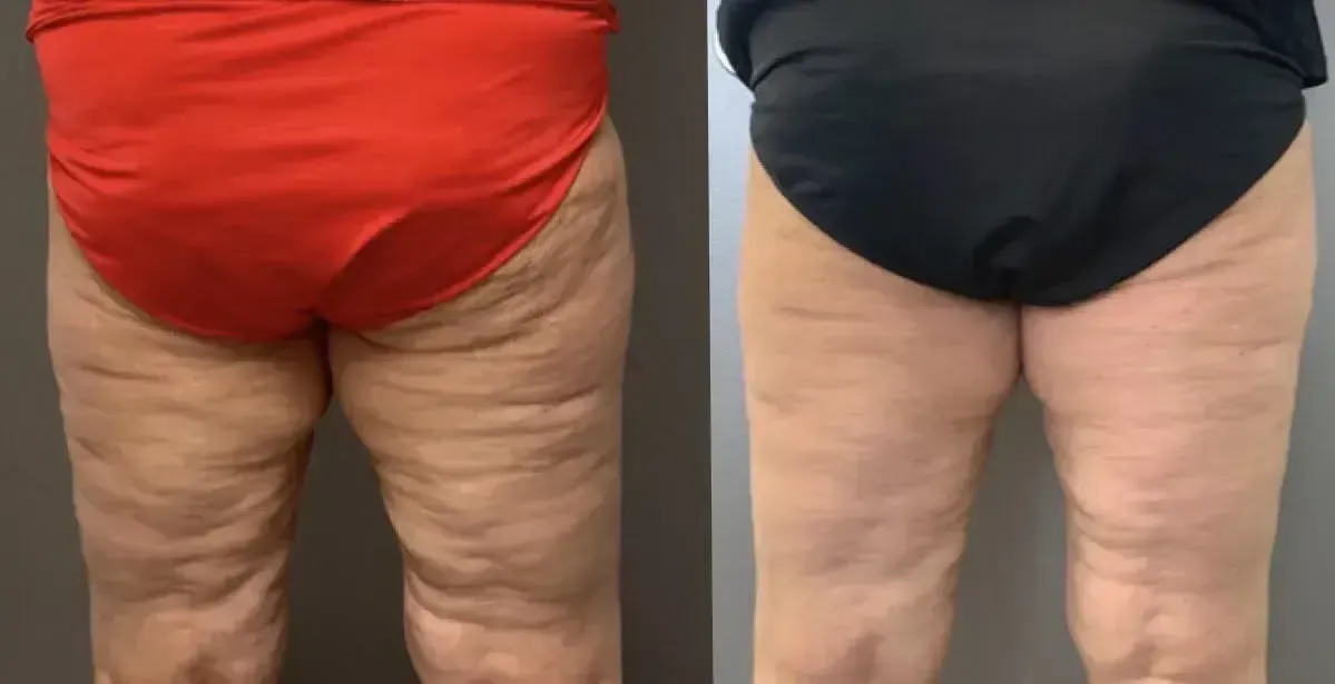 Side-by-side comparison of legs: Before in red briefs, after in black briefs.  Cellulite reduction evident.