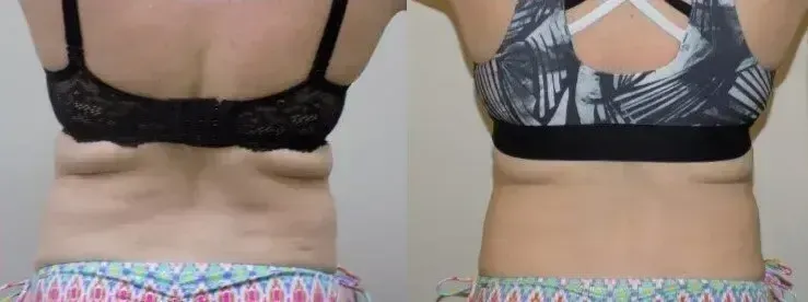 Comparison of a woman's back before and after treatment, showing reduction of back fat.