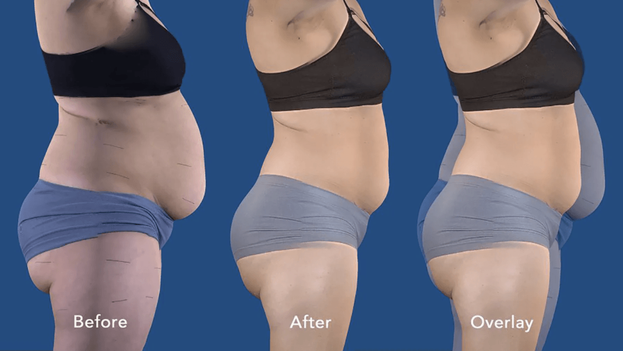 Side-by-side comparison shows a woman's abdomen before and after a procedure, with an overlay highlighting changes.