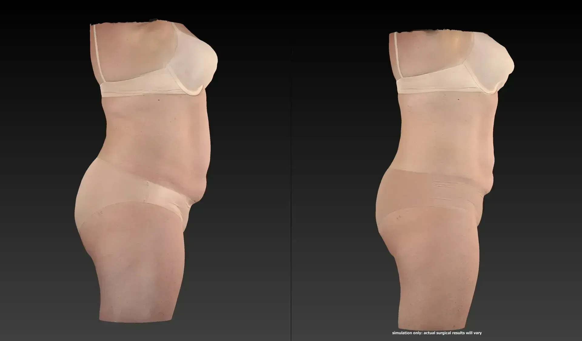 Side-by-side comparison of a person's body in underwear. The left has a rounded abdomen, the right a flatter abdomen.
