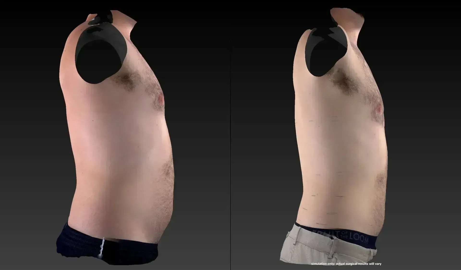 Two side views of a torso, one with a slightly larger belly, both wearing underwear.