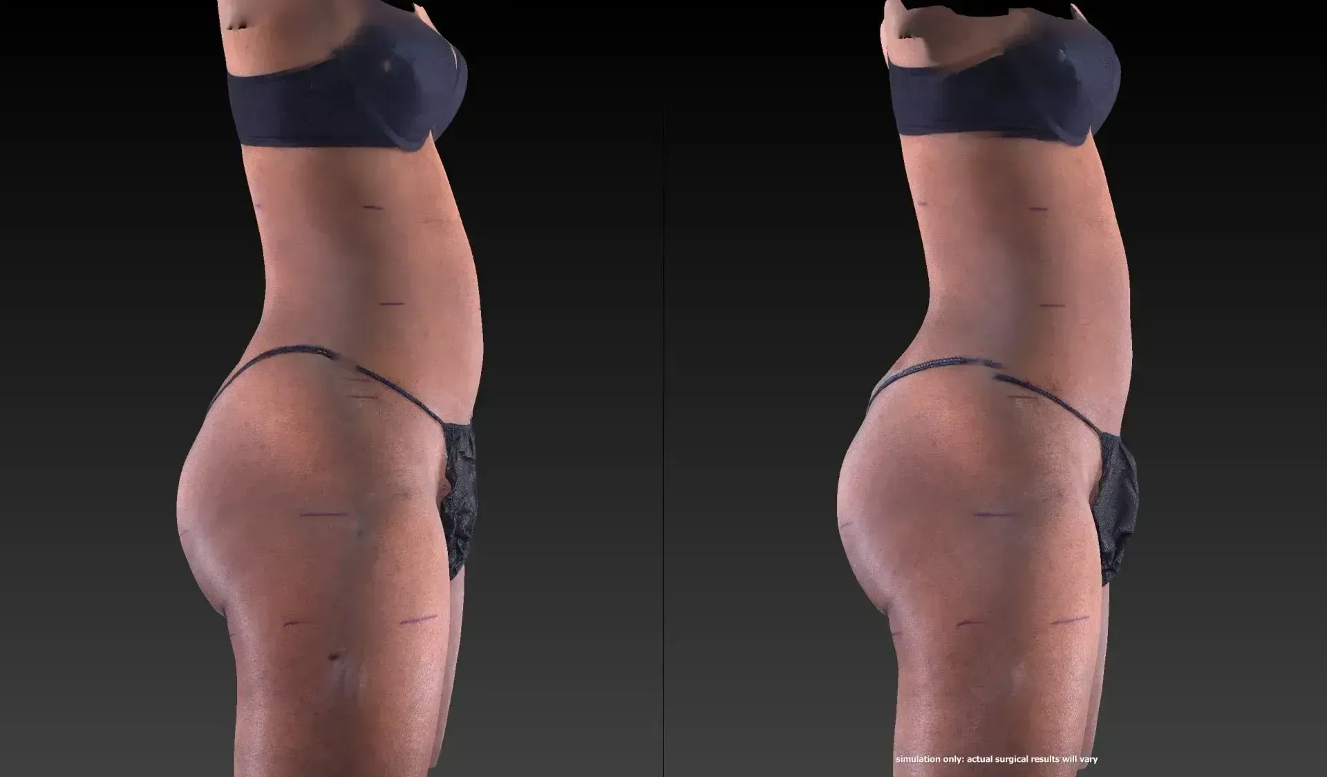 Side-by-side comparison of a person in lingerie; one with a smaller, and the other with a larger posterior.