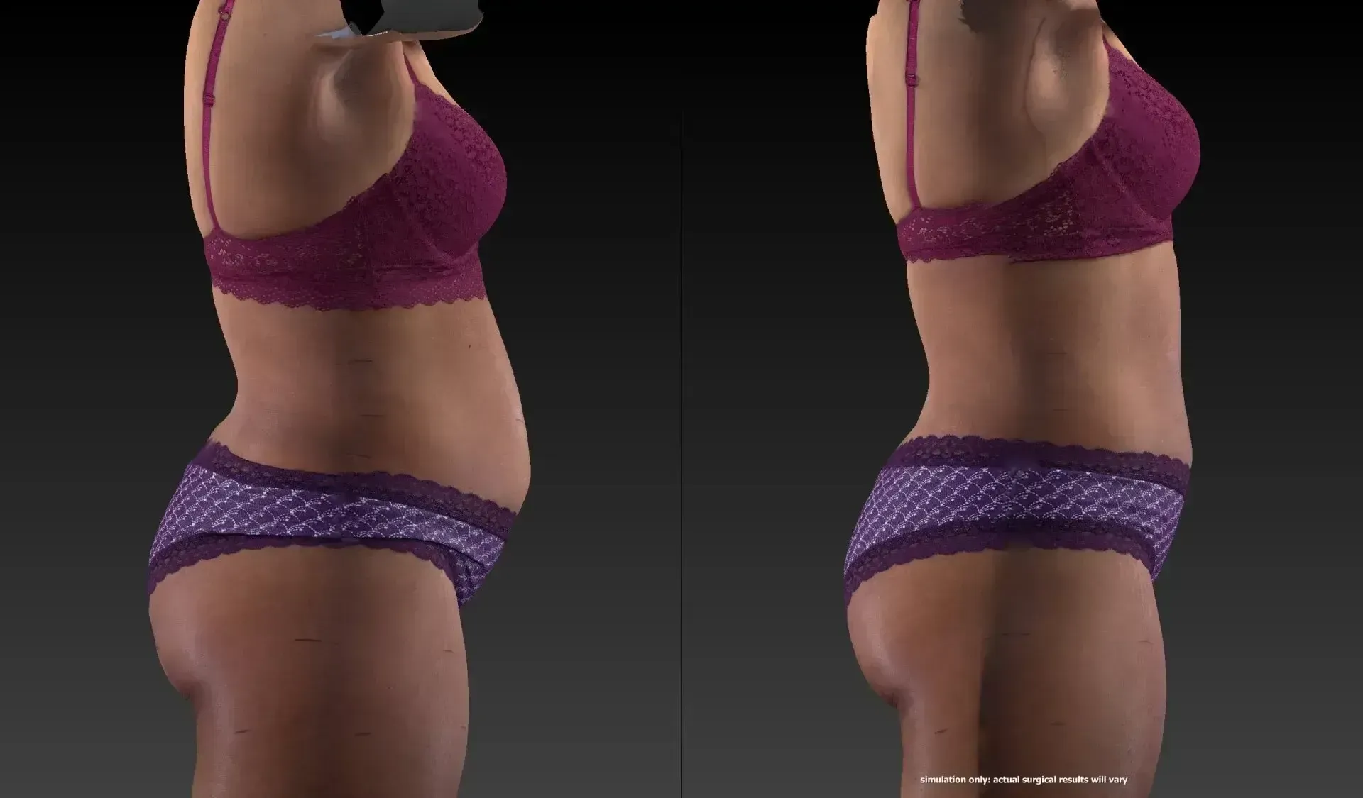 Side-by-side view of a torso in lingerie, showing a visible difference in abdominal profile.