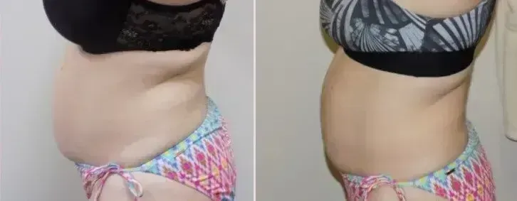 Side-by-side comparison of a person's abdomen before and after a treatment, revealing a visible change in contour.