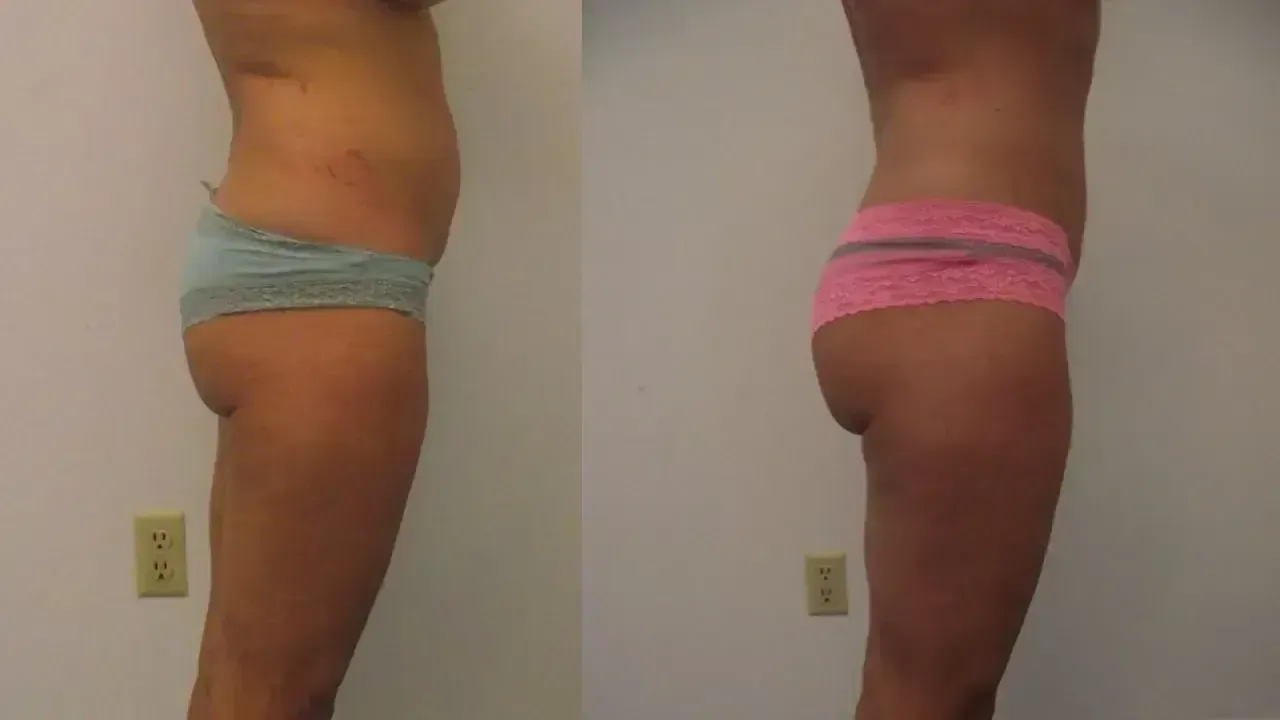 Two side-view photos showing a person's torso and legs, before and after a treatment.