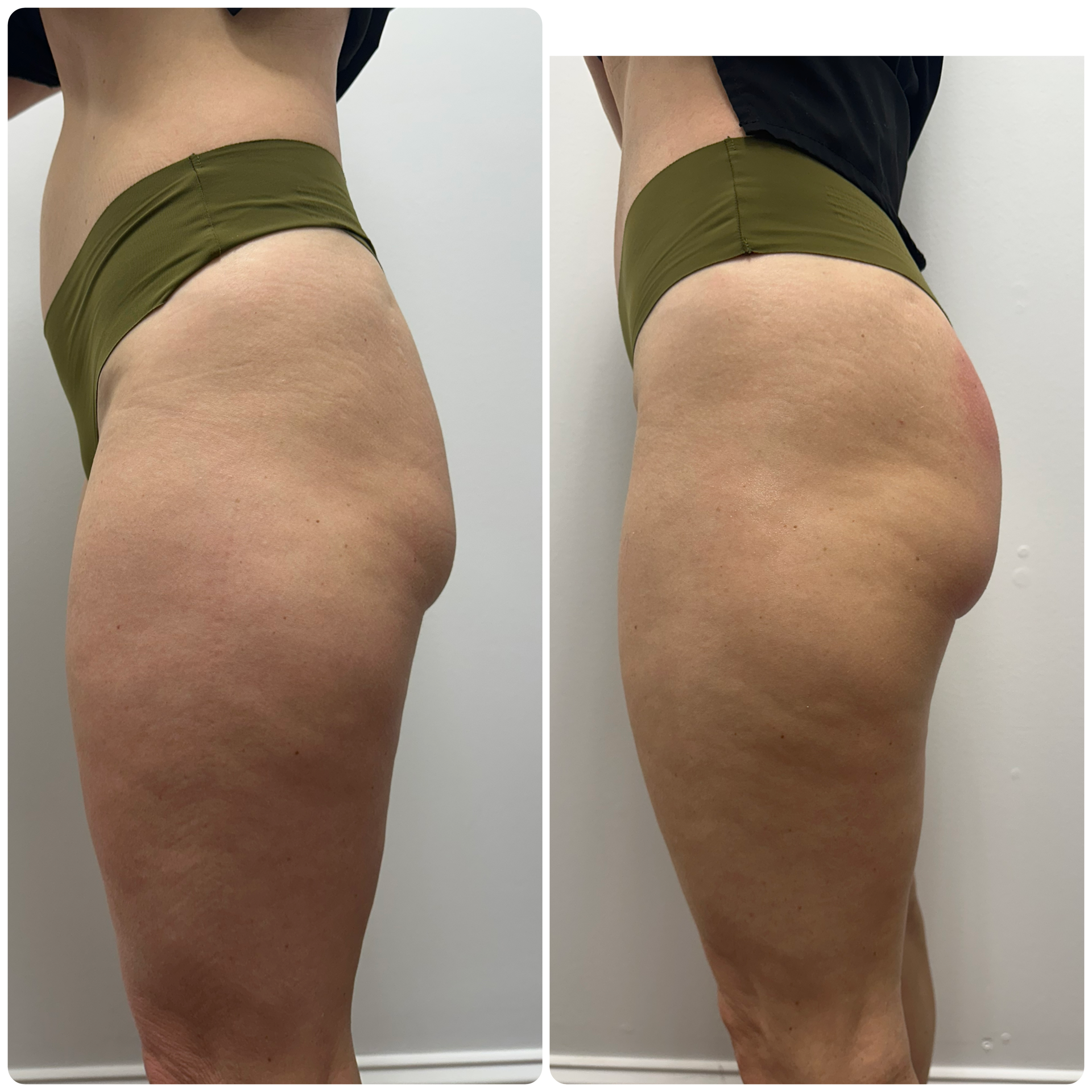 An Artemis T-Shape 2 before and after of a woman's legs and glutes.
