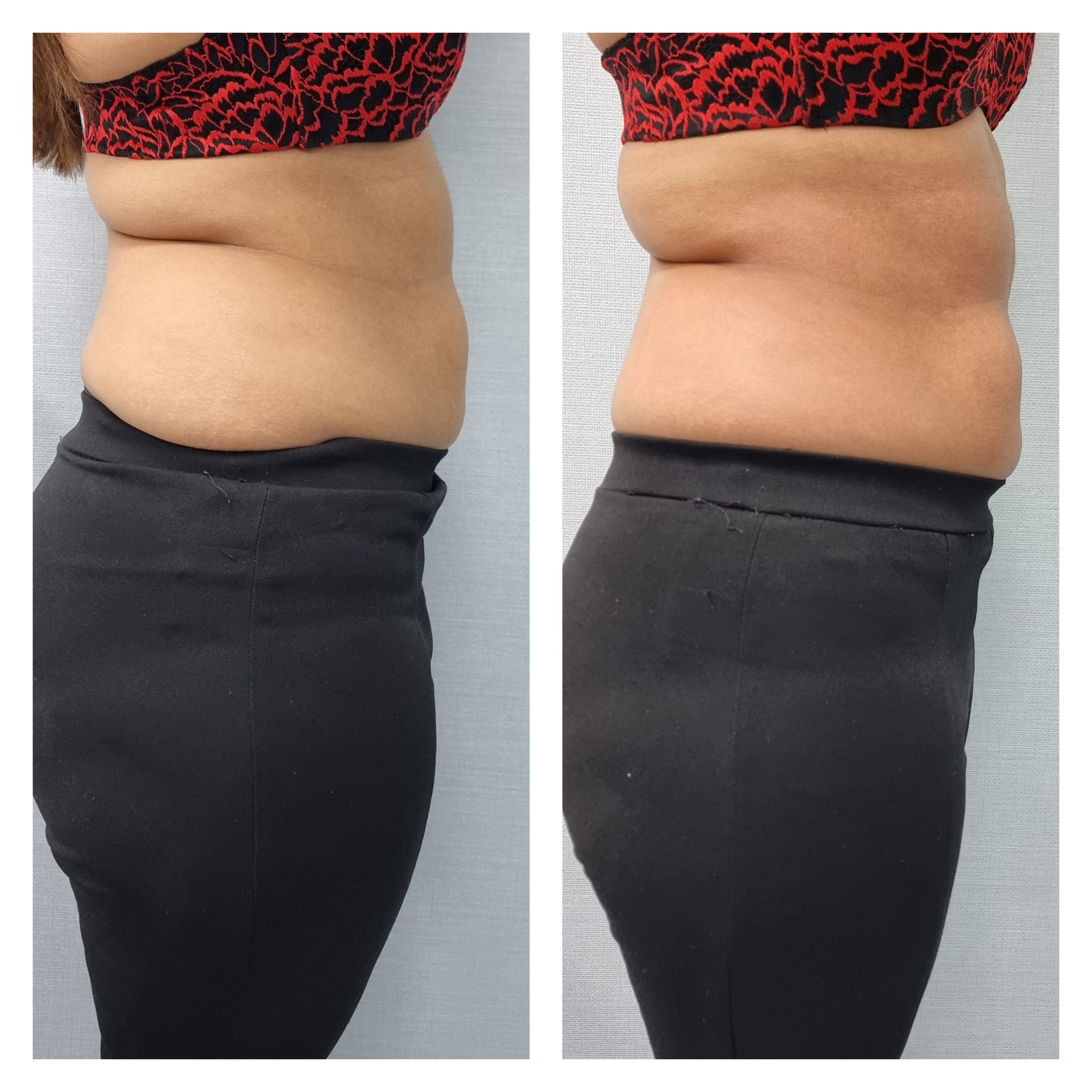 An Artemis T-Shape 2 before and after of a woman's belly.