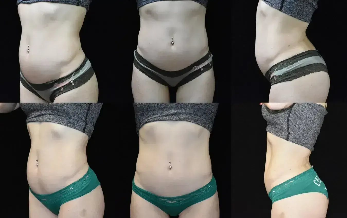 Comparison of a person's abdomen, before and after a body contouring procedure. Shows frontal and side views.