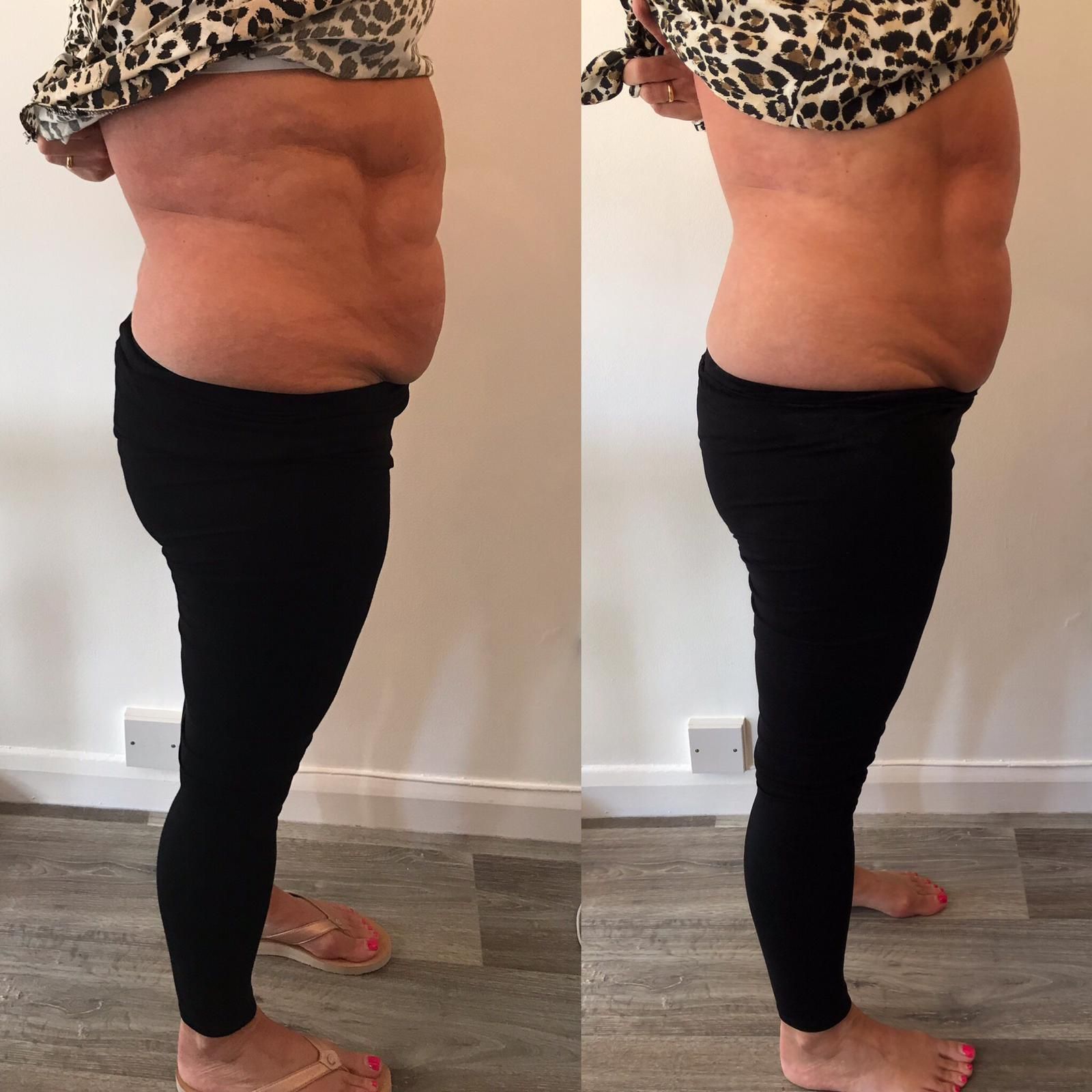 An Artemis T-Shape 2 before and after of a woman's belly.