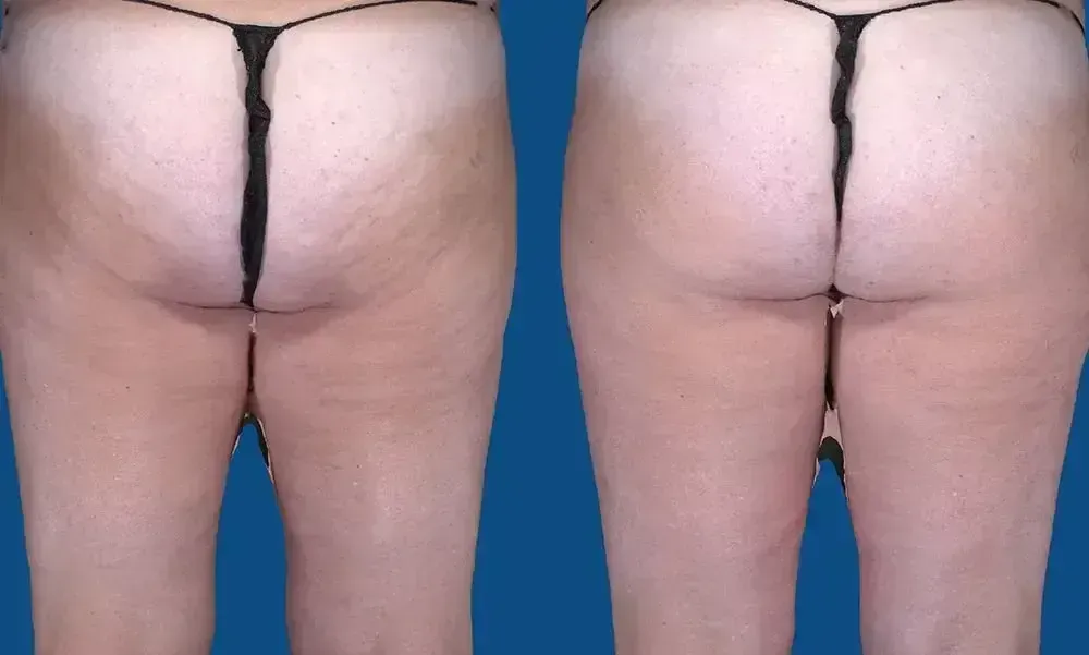 Before and after view of buttocks, showing skin texture changes.