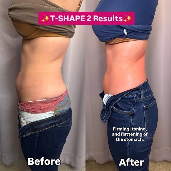 An Artemis T-Shape 2 before and after of a woman's belly.