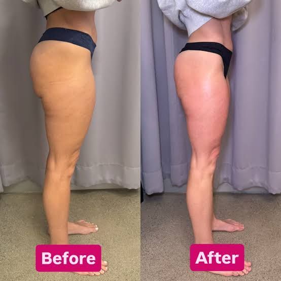 An Artemis T-Shape 2 before and after of a woman's legs.