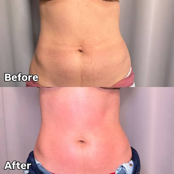 An Artemis T-Shape 2 before and after of a woman's belly.