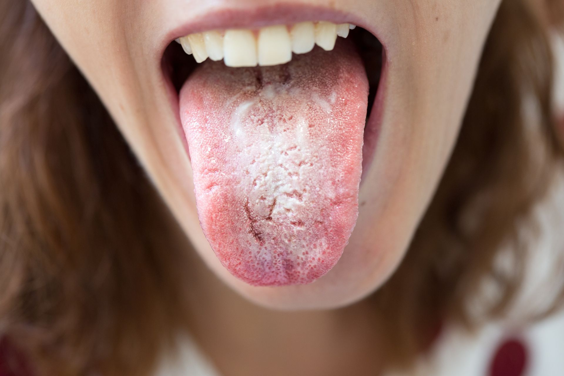 Close-up of a person's open mouth with a coated, white-and-red tongue extended.