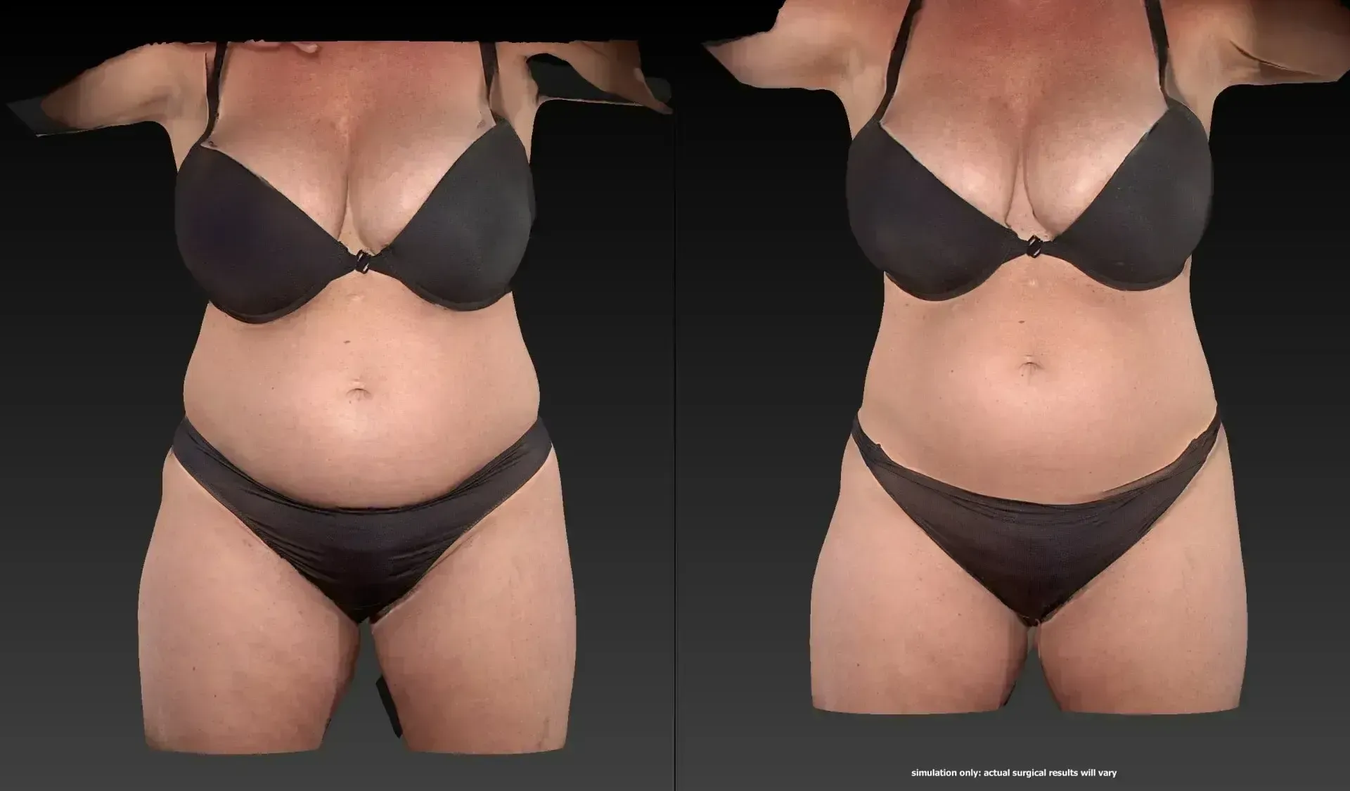 Two frontal views of a person in black lingerie, before and after a body transformation.