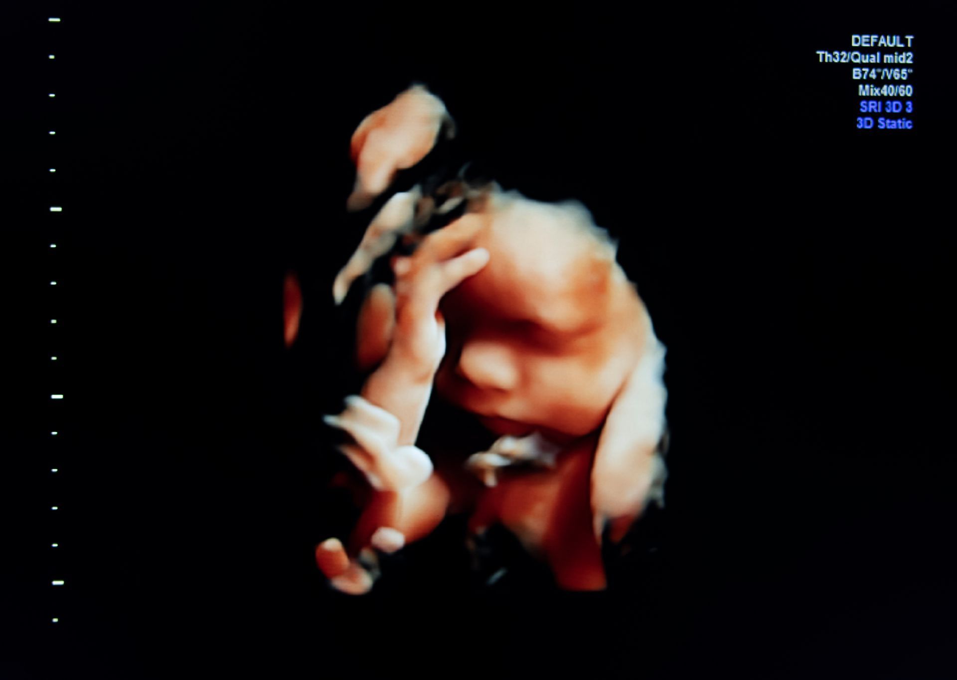 ecografia 3d bambino