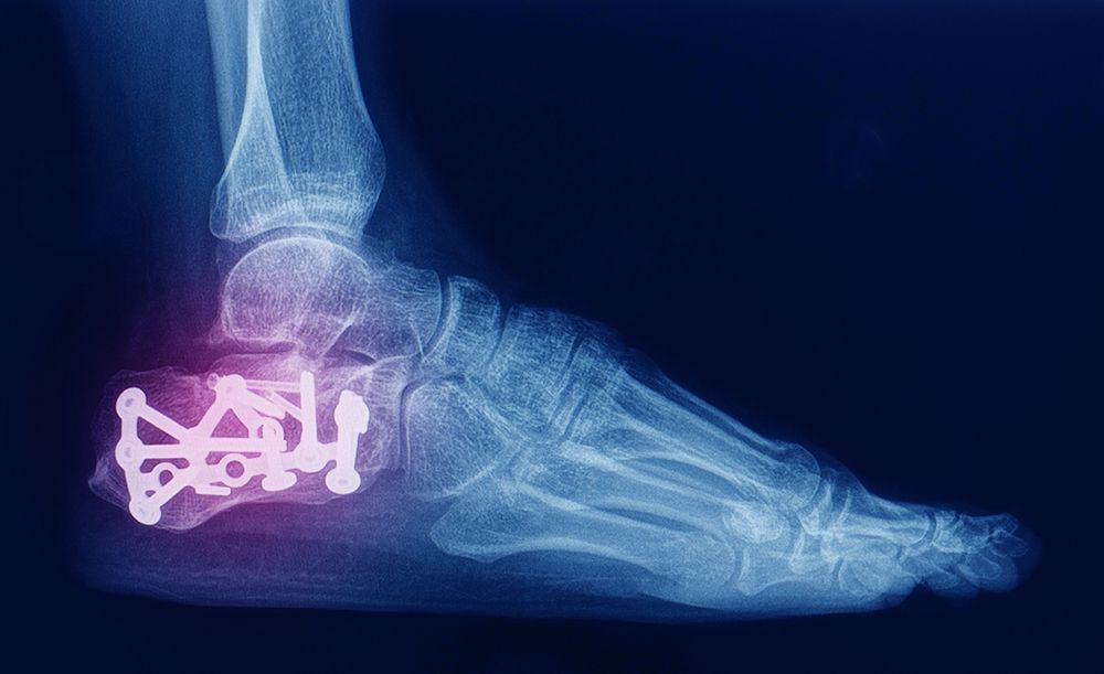 Ankle Implants / Replacements