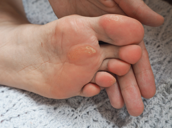 Calluses, Corns, and Bunions Treatment