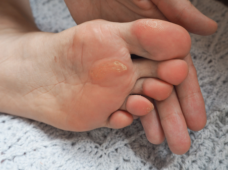 Calluses, Corns, and Bunions Treatment