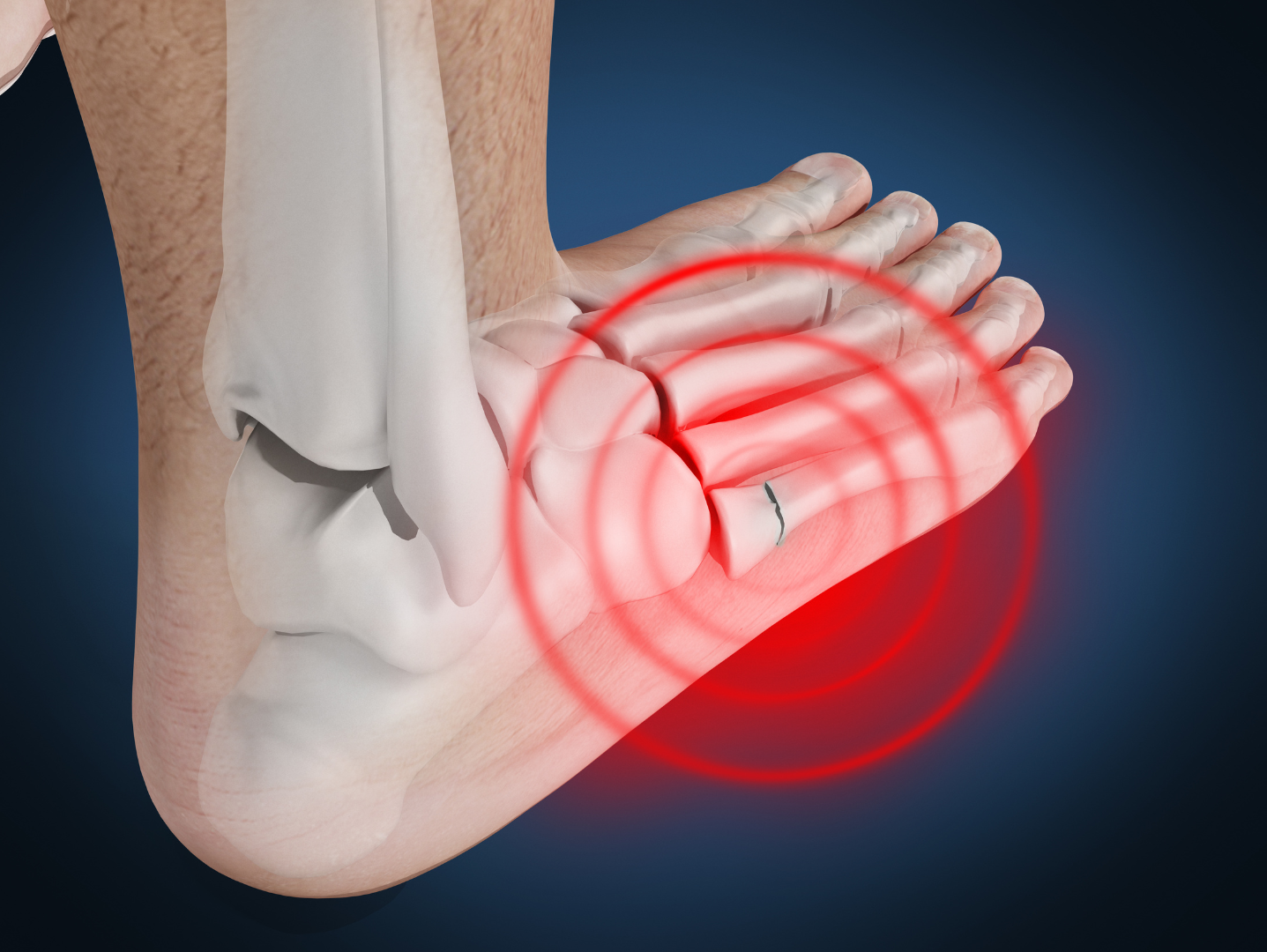 Metatarsal Stress Fractures and Fallen Arches