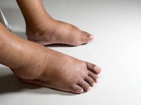 Diabetic Foot Assessments