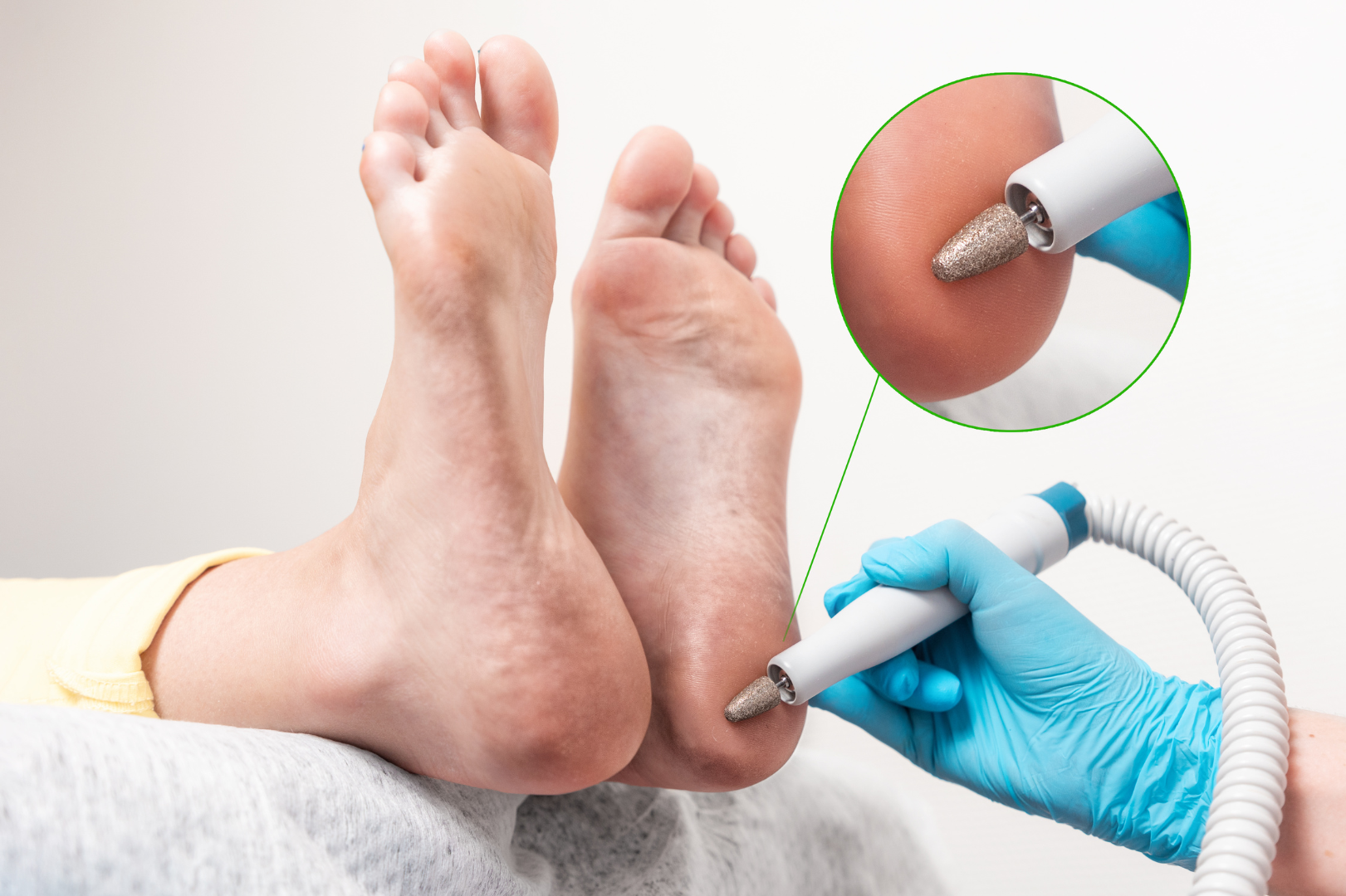 Calluses, corns and bunions treatment singleton