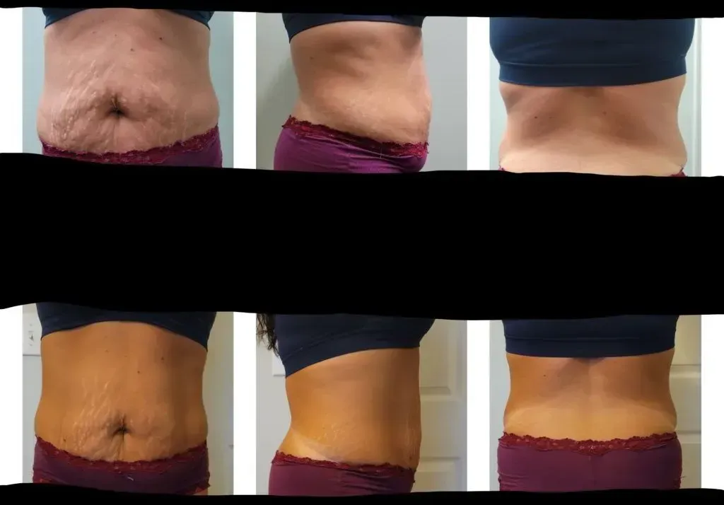 A woman 's stomach is shown before and after surgery.