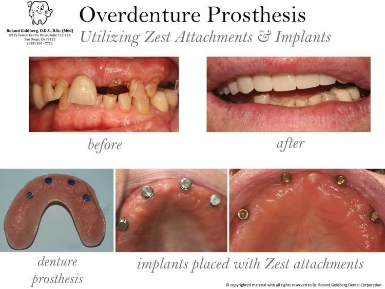 Overdenture Prosthesis — San Diego, CA — Goldberg Dentistry