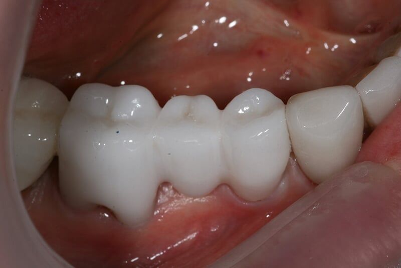 Bridges Restoration — San Diego, CA — Goldberg Dentistry