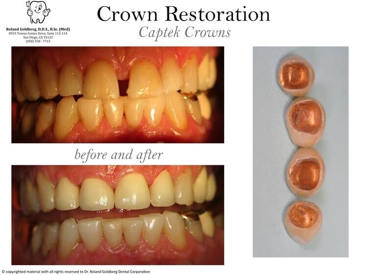 Crowns Restoration — San Diego, CA — Goldberg Dentistry