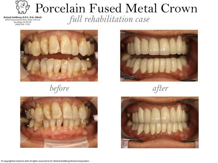 Crowns Restoration — San Diego, CA — Goldberg Dentistry