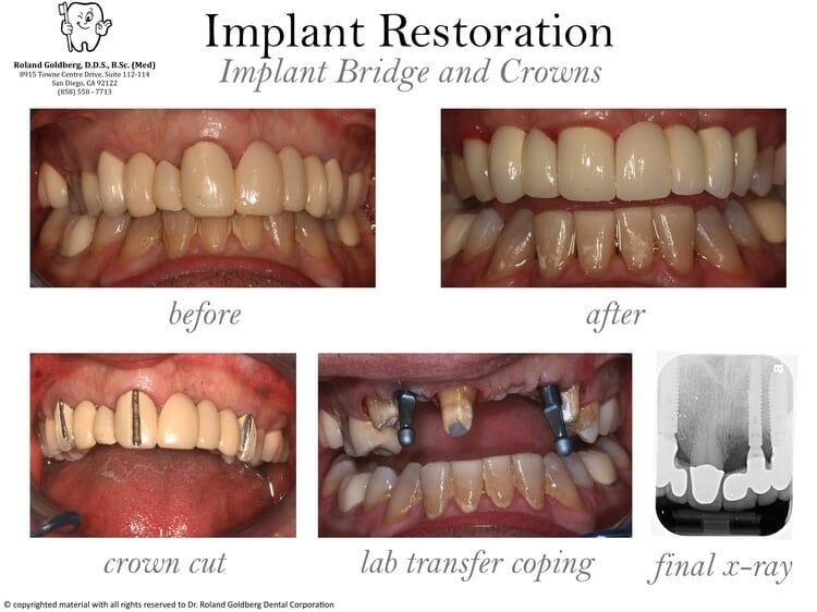 Implant Restoration— San Diego, CA — Goldberg Dentistry
