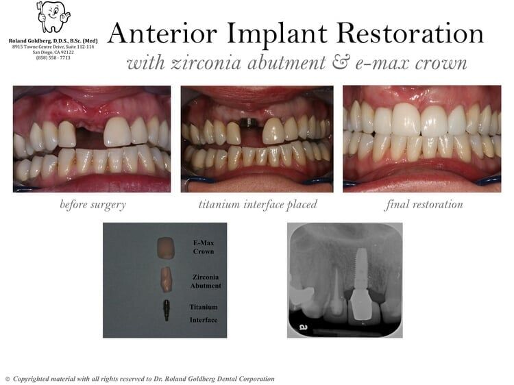 Implants Restoration — San Diego, CA — Goldberg Dentistry