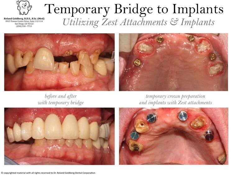Implants Restoration — San Diego, CA — Goldberg Dentistry