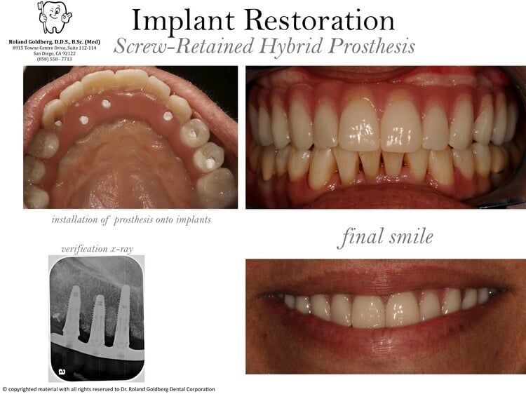 Dental Implants — San Diego, CA — Goldberg Dentistry
