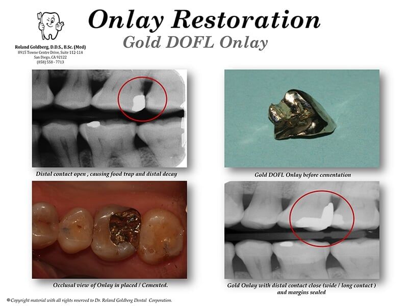 ONLAYS/INLAYS  Restoration — San Diego, CA — Goldberg Dentistry