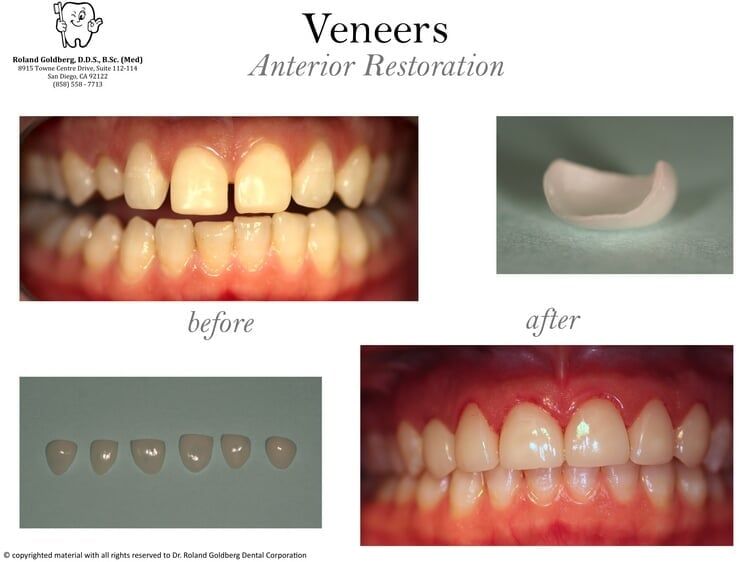 Veneers — San Diego, CA — Goldberg Dentistry