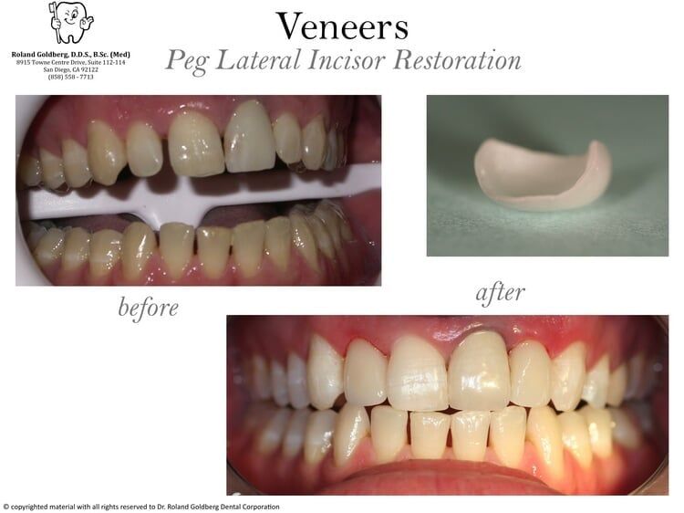 Veneers — San Diego, CA — Goldberg Dentistry