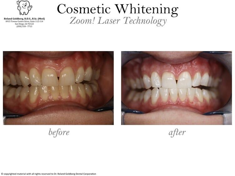 Cosmetic Whitening — San Diego, CA — Goldberg Dentistry