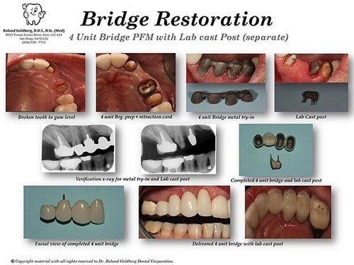 Bridges Restoration — San Diego, CA — Goldberg Dentistry