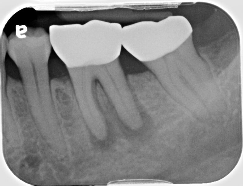 Root Canals — San Diego, CA — Goldberg Dentistry