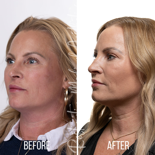 A before and after photo of a woman 's face.