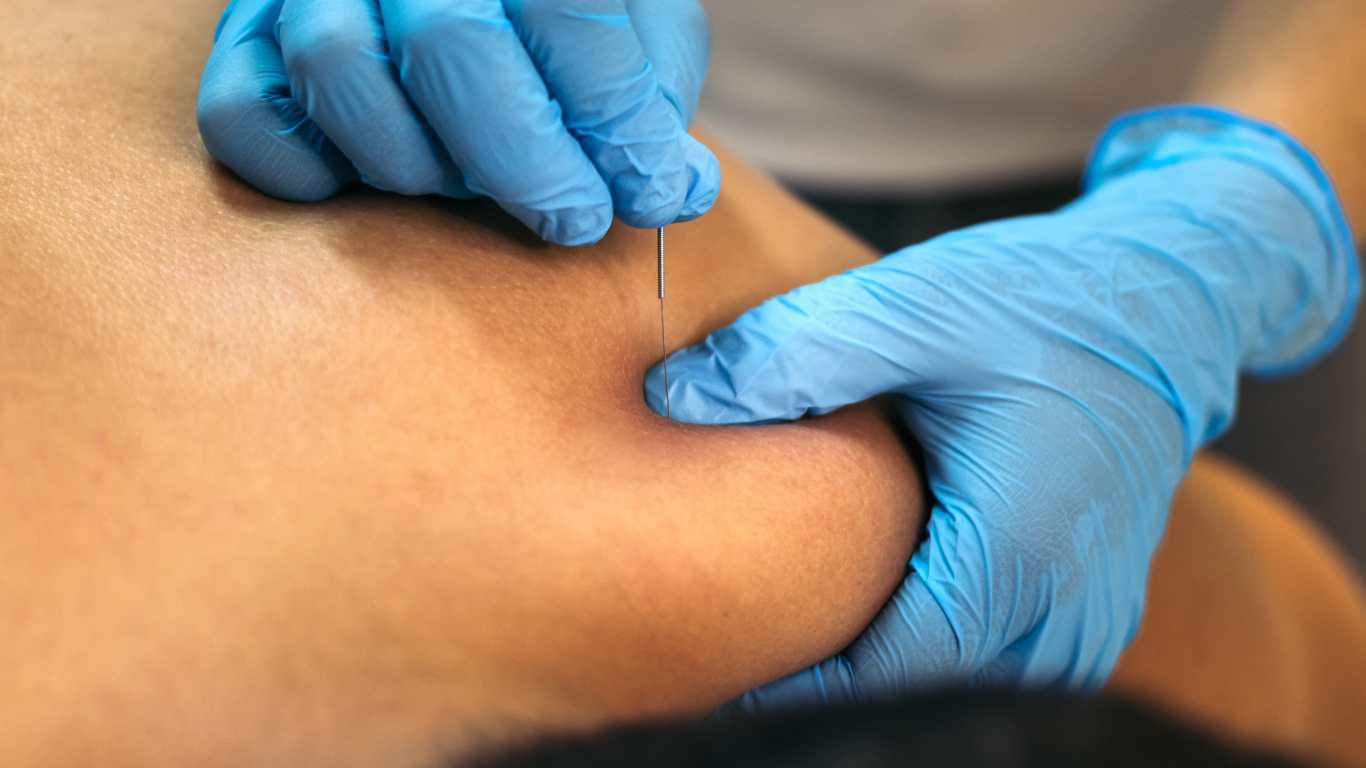 A person wearing blue gloves is getting an acupuncture treatment on their knee.